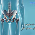 پوکی استخوان و تعویض مفصل در ناحیه لگن