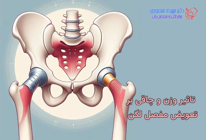 تاثیر وزن و چاقی بر تعویض مفصل لگن