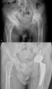 تعویض مفصل لگن (توتال هیپ) چیست؟ راهنمای کامل جراحی تعویض مفصل ران 18 عکس تعویض مفصل لگن