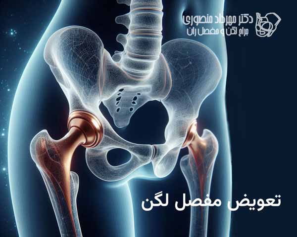 تعویض مفصل لگن