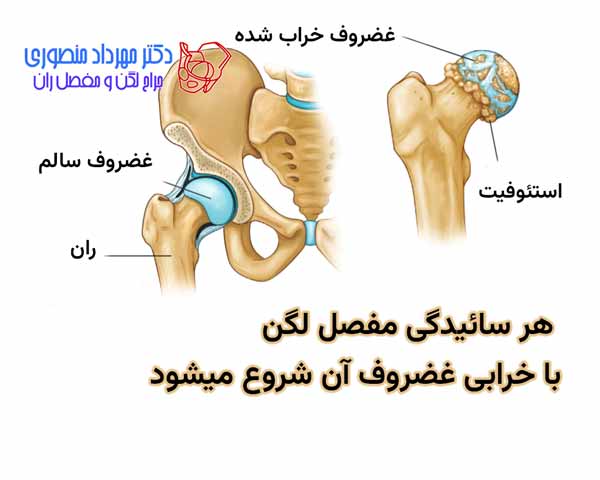 تعویض مفصل لگن (توتال هیپ) چیست؟ راهنمای کامل جراحی تعویض مفصل ران 4 هر ساییدگی مفصل لگن با خرابی غضروف آن شروع میشود