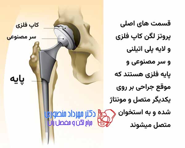 تعویض مفصل لگن (توتال هیپ) چیست؟ راهنمای کامل جراحی تعویض مفصل ران 11 قسمت های اصلی ساختار پروتز لگن