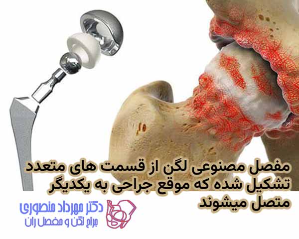 تعویض مفصل لگن (توتال هیپ) چیست؟ راهنمای کامل جراحی تعویض مفصل ران 12 مفصل مصنوعی از قسمت های متعددی درست شده که در موقع جراحی به هم مونتاژ میشوند
