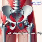 لق و شل شدن مفصل مصنوعی لگن