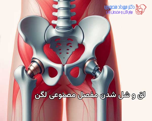لق و شل شدن مفصل مصنوعی لگن