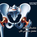 شکستگی اطراف مفصل مصنوعی