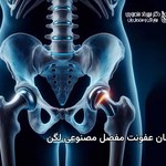 عفونت مفصل مصنوعی