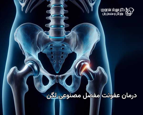 عفونت مفصل مصنوعی