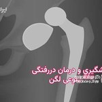 دررفتگی مفصل مصنوعی لگن