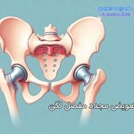 جراحی مجدد و تعویض دوباره مفصل ران