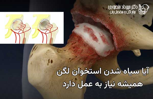 جراحی سیاه شدن استخوان لگن