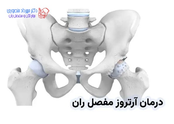 آرتروز و ساییدگی لگن چیست