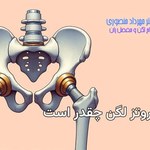عمر پروتز لگن