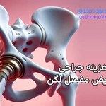 هزینه جراحی تعویض مفصل لگن