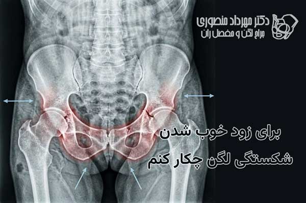 برای زود خوب شدن شکستگی لگن چکار کنم