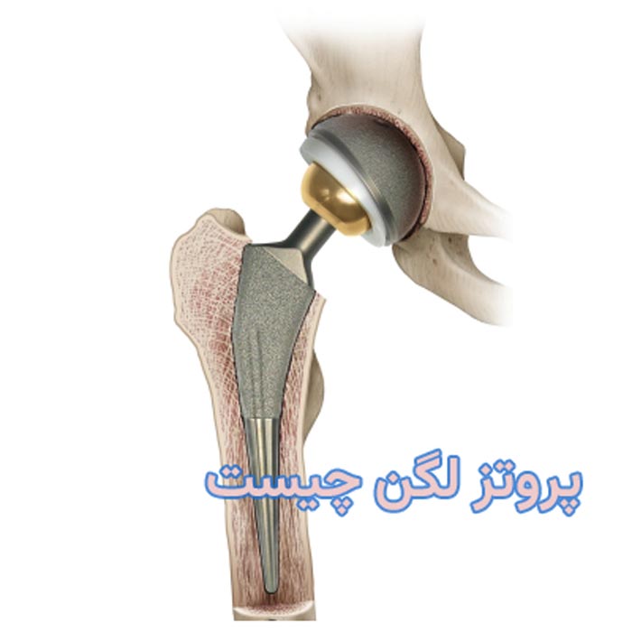 پروتز لگن چیست
