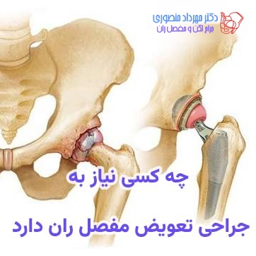 چه کسی نیاز به تعویض مفصل ران دارد