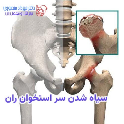 سیاه شدن استخوان لگن