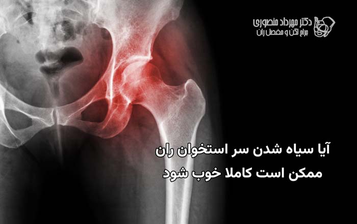 femoral head necrosis recovery 1