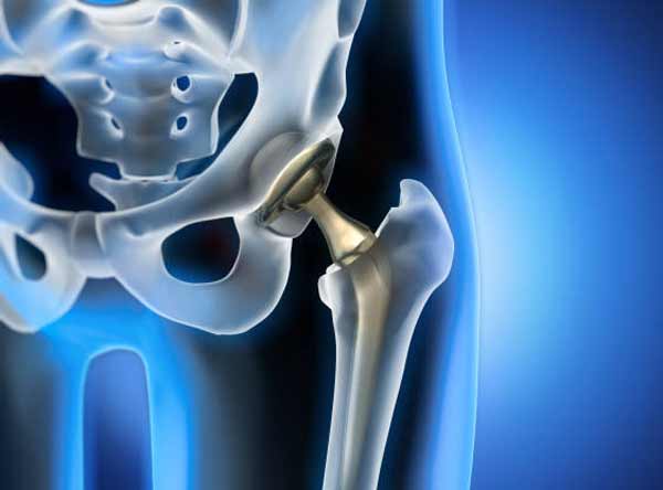 pain after hip replacemant featured
