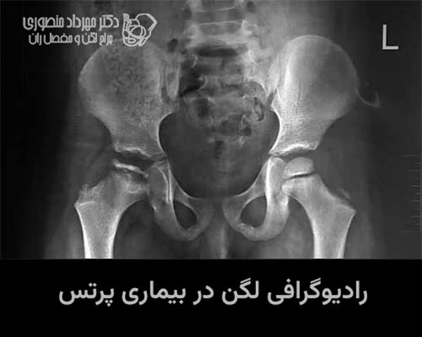 بیماری لگ کالو پرتس در کودکان. علائم، مراحل و درمان 3 پهن شدن سر استخوان ران راست بر اثر بیماری پرتس. رادیوگرافی
