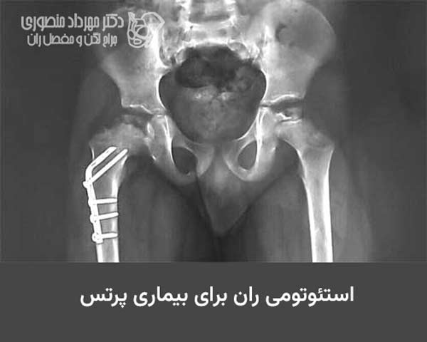 بیماری لگ کالو پرتس در کودکان. علائم، مراحل و درمان 8 جراحی استئوتومی ران راست برای بیماری پرتس