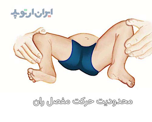 عکس دررفتگی لگن نوزاد. محدودیت در باز شدن مفصل ران در دررفتگی مادرزادی لگن