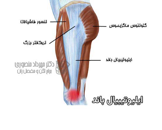 صدا دادن لگن. ایلیوتیبیال باند کجای لگن و ران است