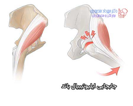 علت صدا دادن مفصل لگن ممکن است جابجایی ایلیوتیبیال باند به جلو و عقب تروکانتر بزرگ باشد