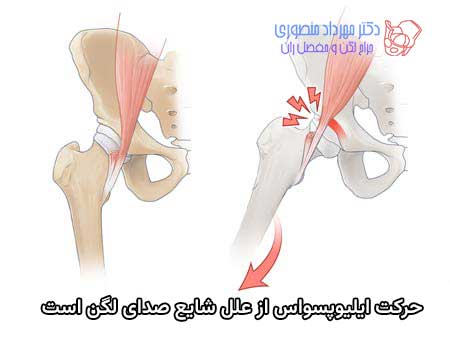 علت صدا دادن لگن میتواند جابجایی تاندون ایلیوپسواس در جلوی مفصل ران باشد