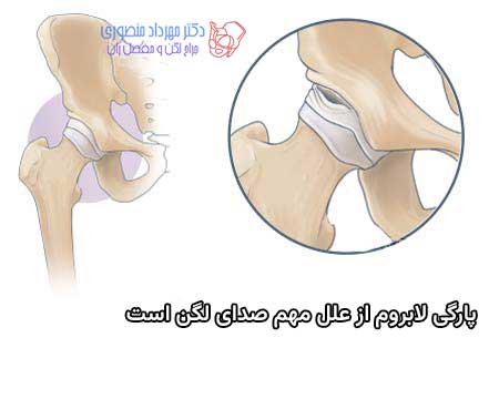 علت صدا دادن مفصل لگن میتواند پارگی لابروم باشد