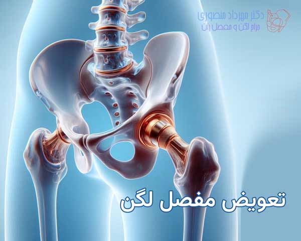 تعویض مفصل لگن (توتال هیپ) چیست؟ راهنمای کامل جراحی تعویض مفصل ران 5 جراحی تعویض مفصل لگن چیست و چگونه انجام میشود