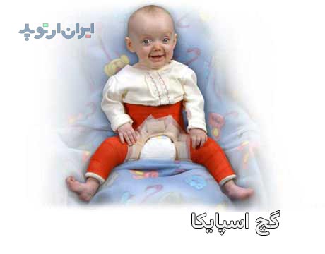 عکس دررفتگی لگن نوزاد که با استفاده از گچ گیری تنه و ران ها که به آن اسپایکا میگویند درمان میشود