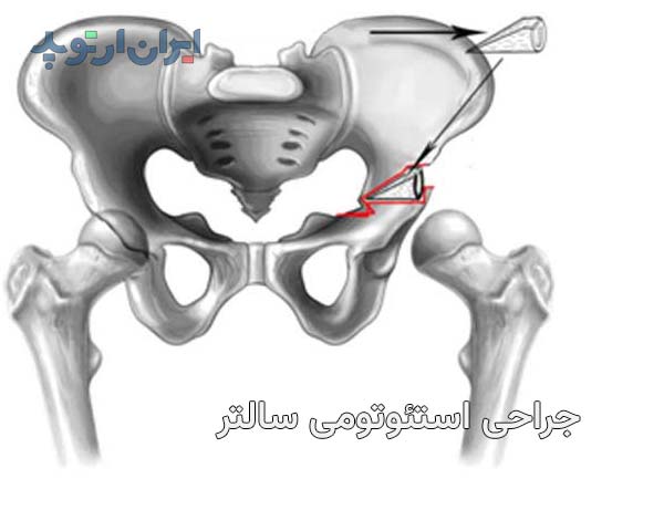 عمل جراحی دررفتگی لگن مادرزادی با استئوتومی سالتر