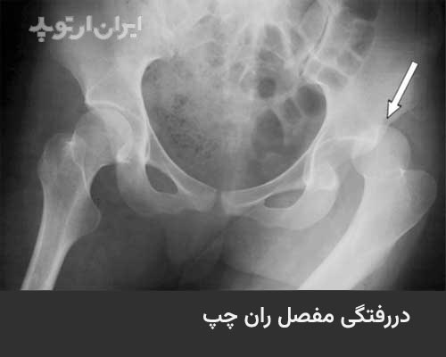دررفتگی لگن بر اثر ضربه و تصادف: علائم، درمان و عوارض 5 عکس دررفتگی لگن بر اثر ضربه