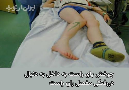 دررفتگی لگن بر اثر ضربه و تصادف: علائم، درمان و عوارض 7 چرخش ران به داخل و ادداکشن آن بدنبال از علائم دررفتگی لگن است