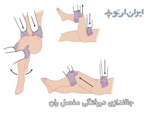 دررفتگی لگن بر اثر ضربه و تصادف: علائم، درمان و عوارض 9 جا انداختن دررفتگی لگن
