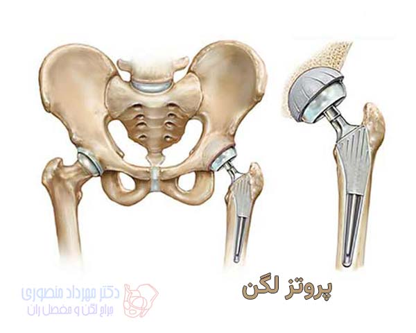 پروتز لگن چیست و چند نوع دارد 2 پروتز لگن یا مفصل مصنوعی ران