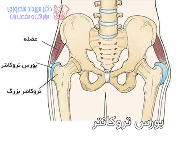 انواع بورسیت لگن و علائم و درمان هر کدام 4 بورس تروکانتر کجای لگن است
