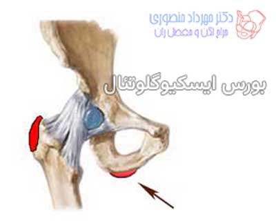انواع بورسیت لگن و علائم و درمان هر کدام 3 بورس ایسکیوگلوتئال