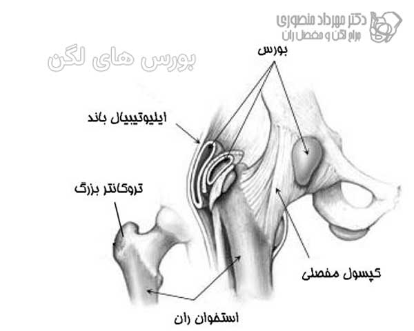 انواع بورسیت لگن و علائم و درمان هر کدام 5 مهم ترین بورس هاس لگن کجا هستند