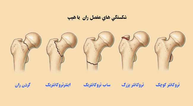 انواع شکستگی هیپ یا مفصل ران