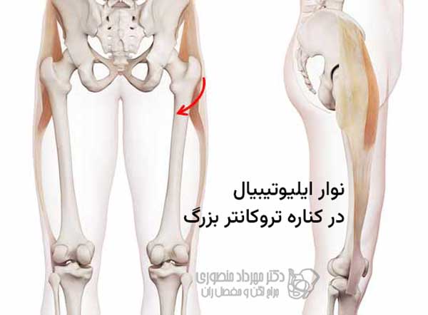 نوار ایلیوتیبیال در کناره تروکانتر بزرگ
