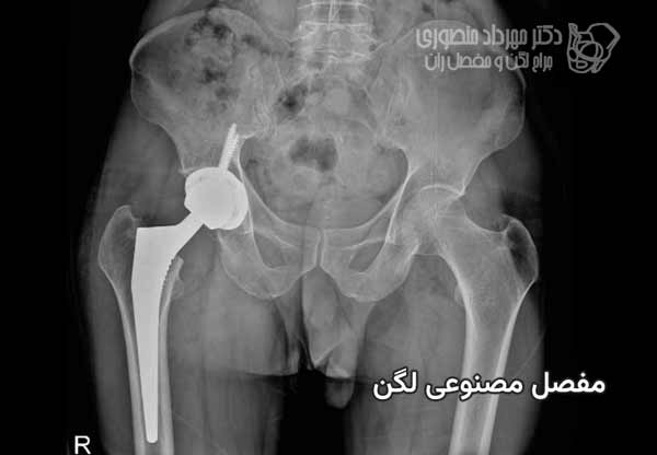 تعویض مفصل لگن (توتال هیپ) چیست؟ راهنمای کامل جراحی تعویض مفصل ران 13 عکس مفصل مصنوعی بعد از جراحی تعویض مفصل
