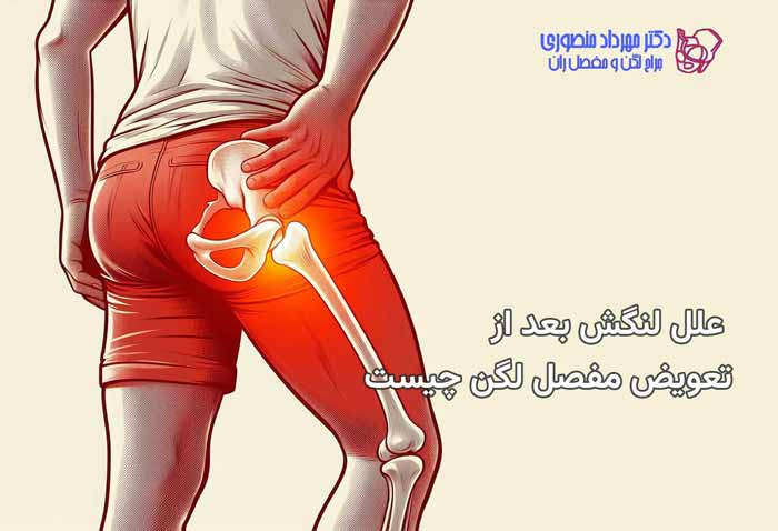 علت لنگش بعد از عمل تعویض مفصل لگن چیست 2 لنگش بعد از تعویض مفصل در ناحیه لگن