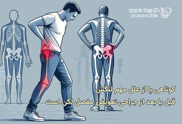 علت لنگش بعد از عمل تعویض مفصل لگن چیست 5 کوتاهی پا و لنگش بعد از عمل تعویض مفصل