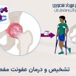 عفونت چرکی مفصل ران