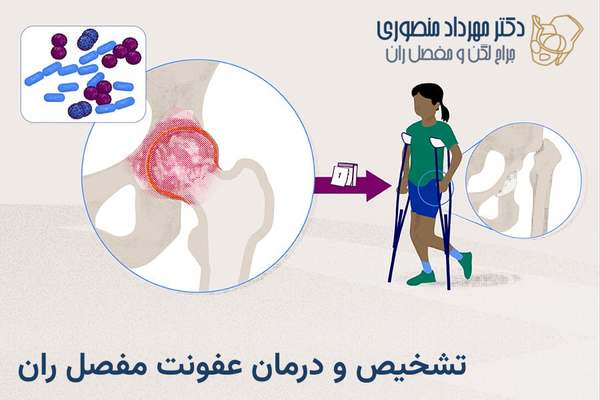 عفونت مفصل ران (آرتریت سپتیک لگن): علائم، تشخیص و درمان 1 عفونت چرکی مفصل ران