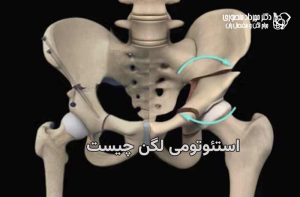 استئوتومی لگن چیست