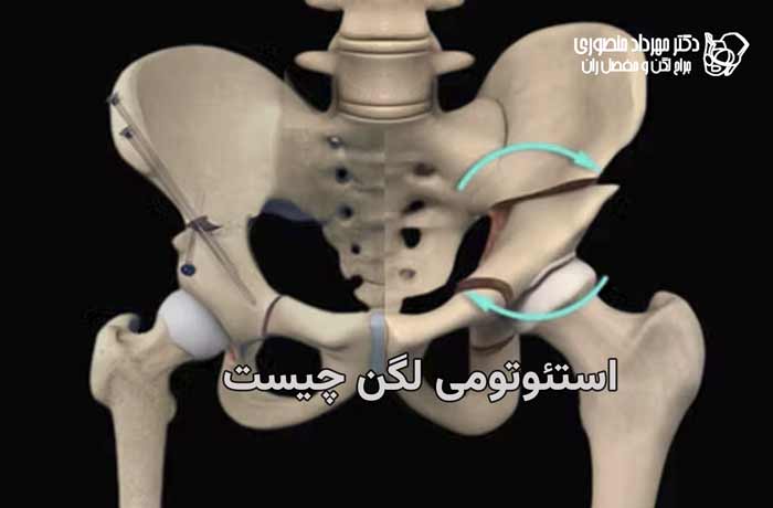 استئوتومی لگن چیست و برای چه کسانی انجام میشود 1 استئوتومی لگن چیست